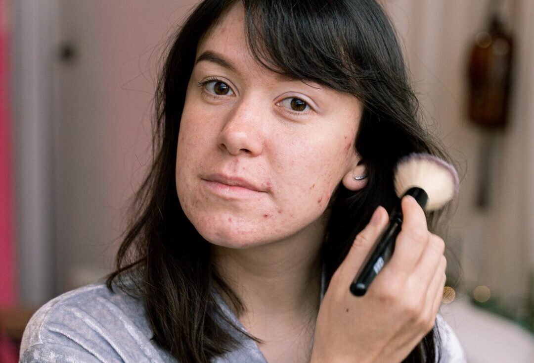 woman's face with PORES and acne