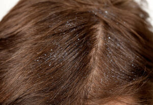 dandruff